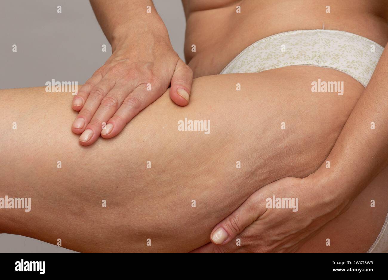 Corpo femminile corto con le mani sulla gamba che preme la pelle per mostrare la cellulite Foto Stock