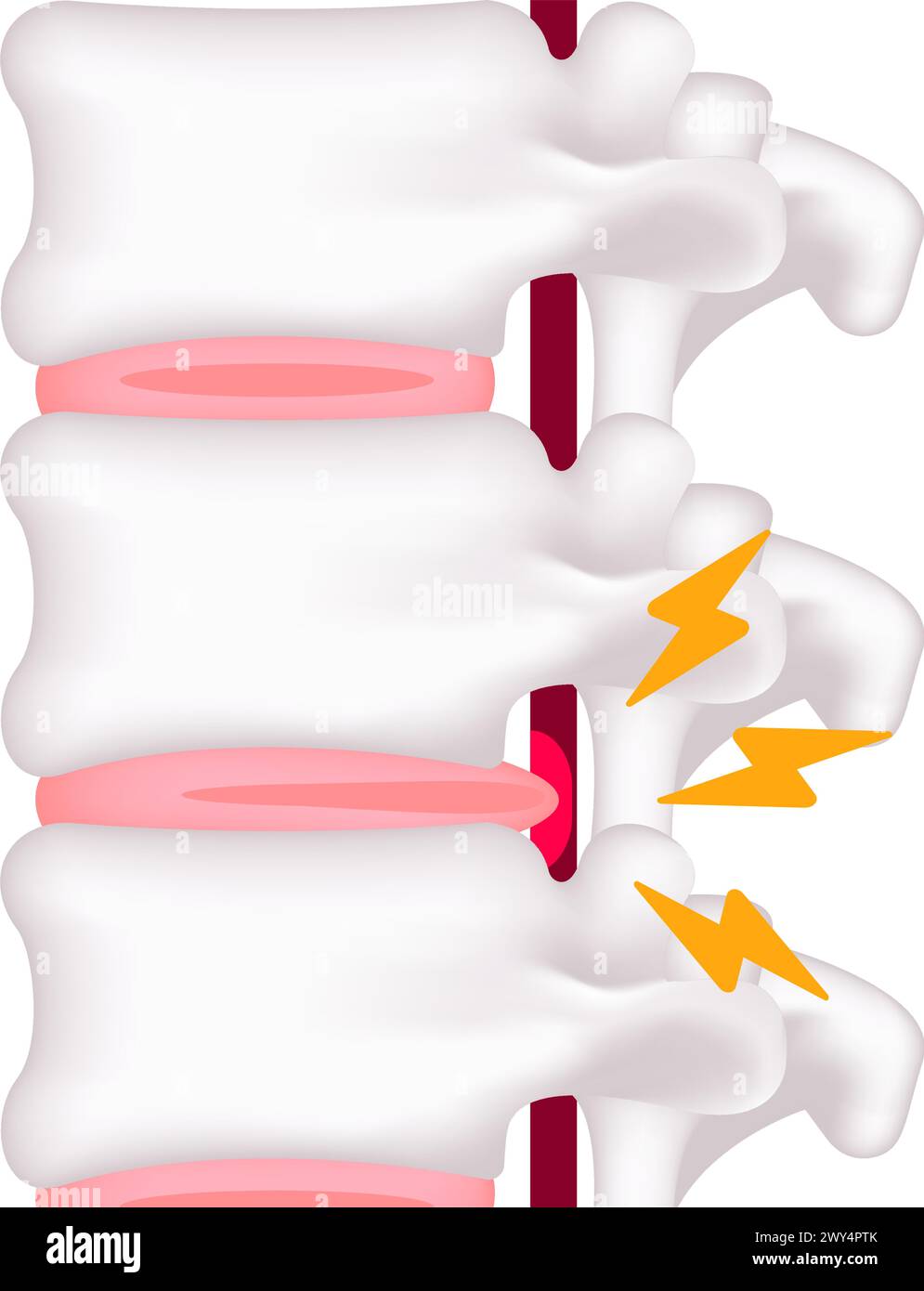 Illustrazione del vettore di erniazione del disco spinale Illustrazione Vettoriale