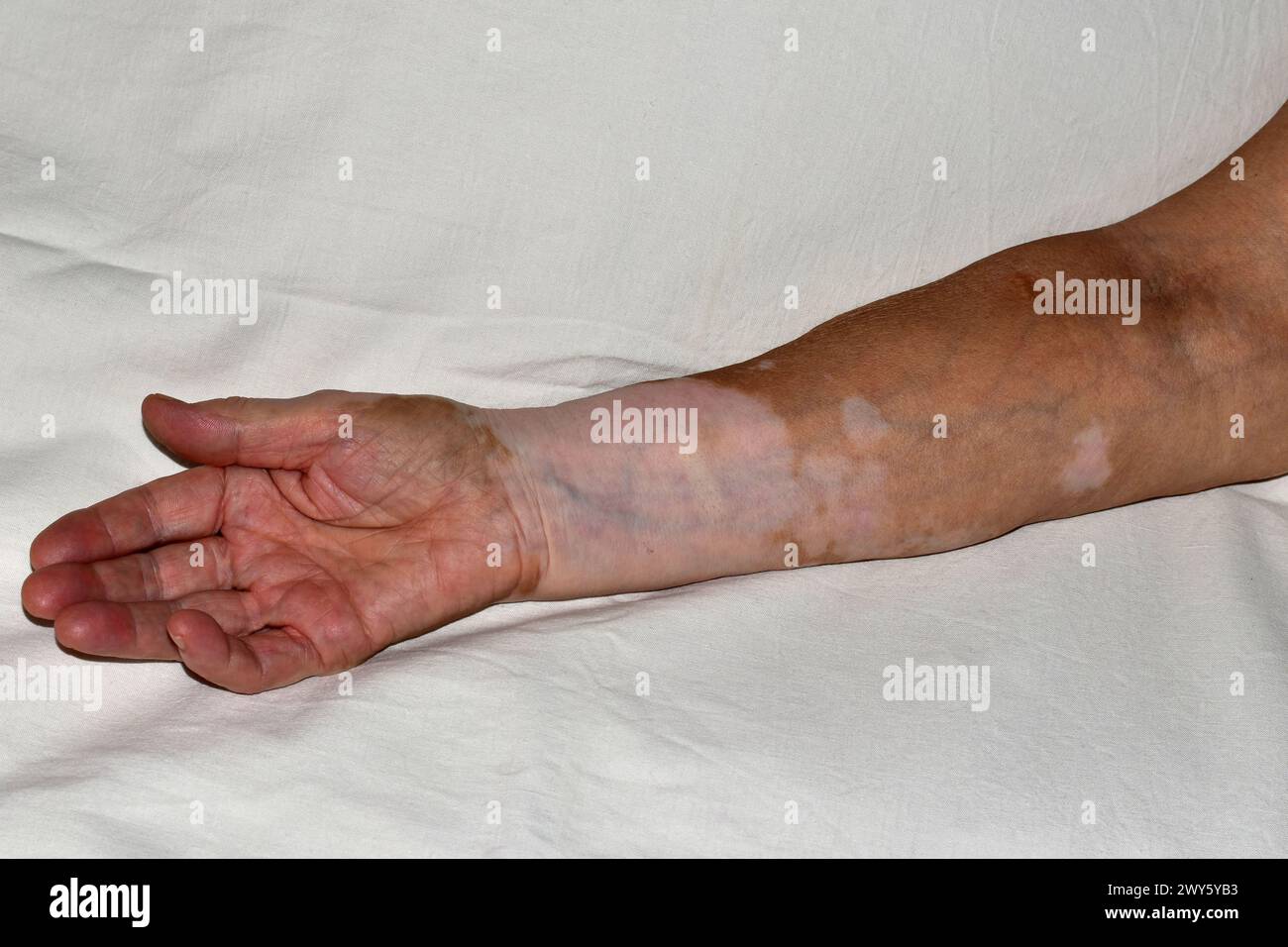 L'immagine mostra un primo piano della mano destra di una donna anziana danneggiata da malattia della vitiligine, palma su Foto Stock