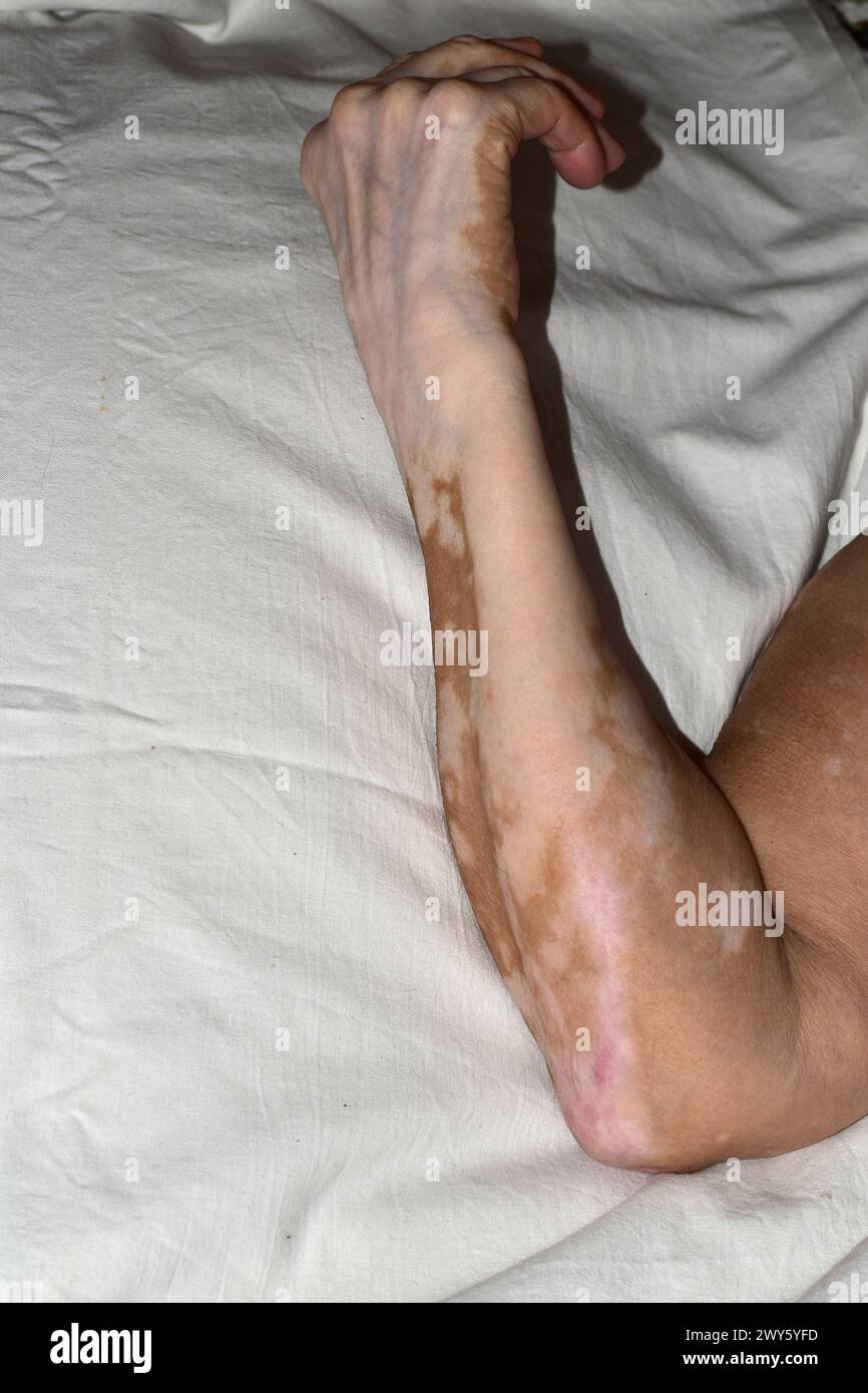 L'immagine mostra un primo piano del braccio destro piegato al gomito, una donna più anziana danneggiata dalla malattia della vitiligine, giacente sul bianco. Foto Stock