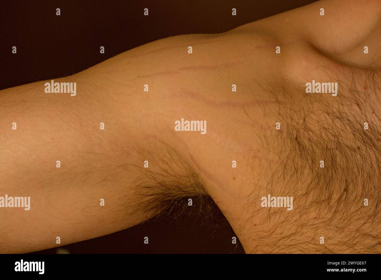 Esplora l'impatto dei cambiamenti di peso, tra cui l'obesità e l'aumento muscolare, sul corpo maschile attraverso questa interessante immagine che cattura le smagliature Foto Stock