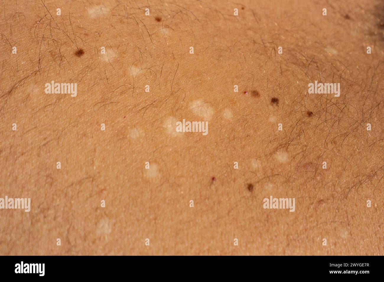 Cattura la complessità visiva della tinea versicolor, una comune infezione fungina della pelle, con questa immagine ad alta risoluzione Foto Stock