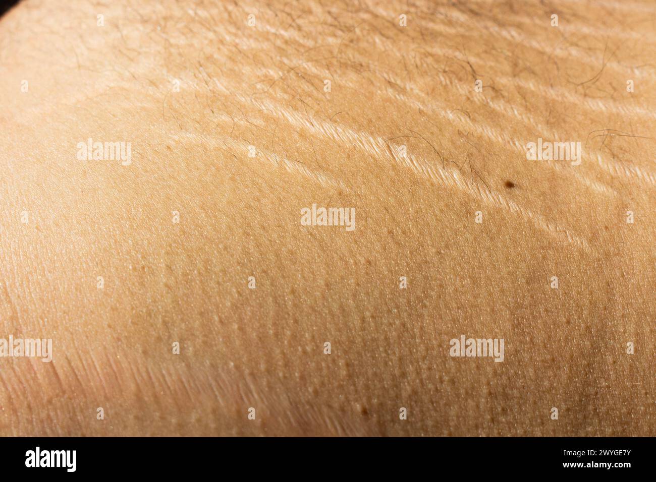 Esplora l'impatto dei cambiamenti di peso, tra cui l'obesità e l'aumento muscolare, sul corpo maschile attraverso questa interessante immagine che cattura le smagliature Foto Stock