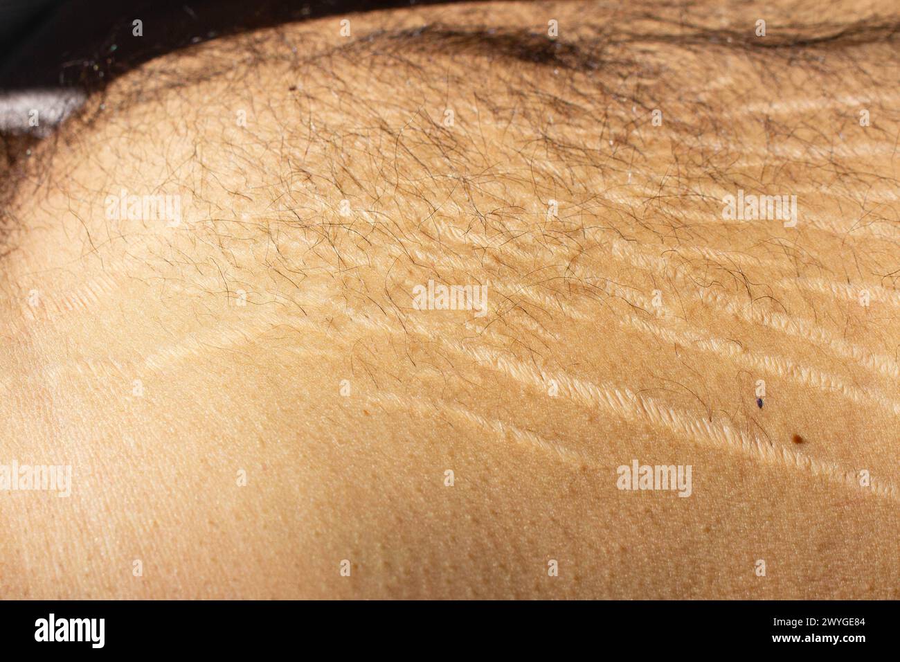 Esplora l'impatto dei cambiamenti di peso, tra cui l'obesità e l'aumento muscolare, sul corpo maschile attraverso questa interessante immagine che cattura le smagliature Foto Stock