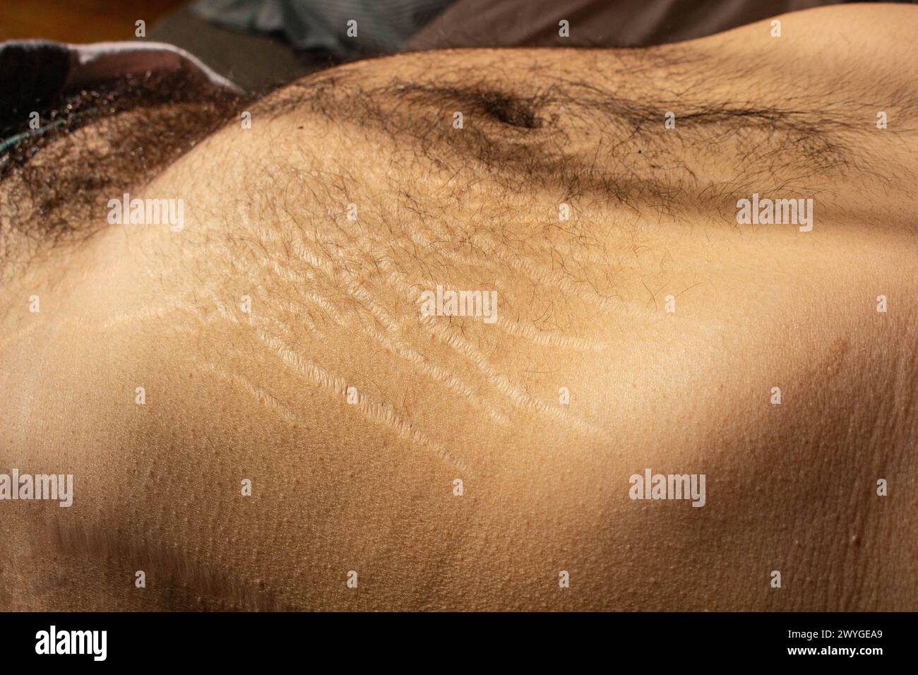 Esplora l'impatto dei cambiamenti di peso, tra cui l'obesità e l'aumento muscolare, sul corpo maschile attraverso questa interessante immagine che cattura le smagliature Foto Stock