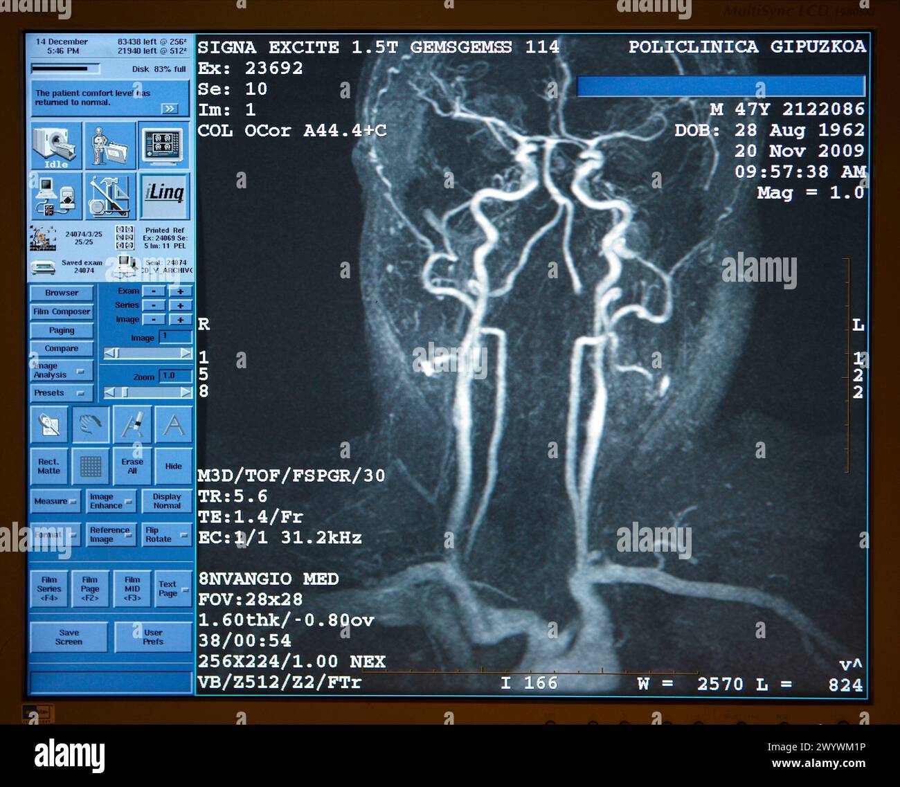 Arterie succlave e carotide e cerchio di Willis, MRI (Magnetic Resonance Imaging), imaging medico per la diagnosi. Ospedale Policlinica Gipuzkoa, San Sebastian, Donostia, Euskadi, Spagna. Foto Stock