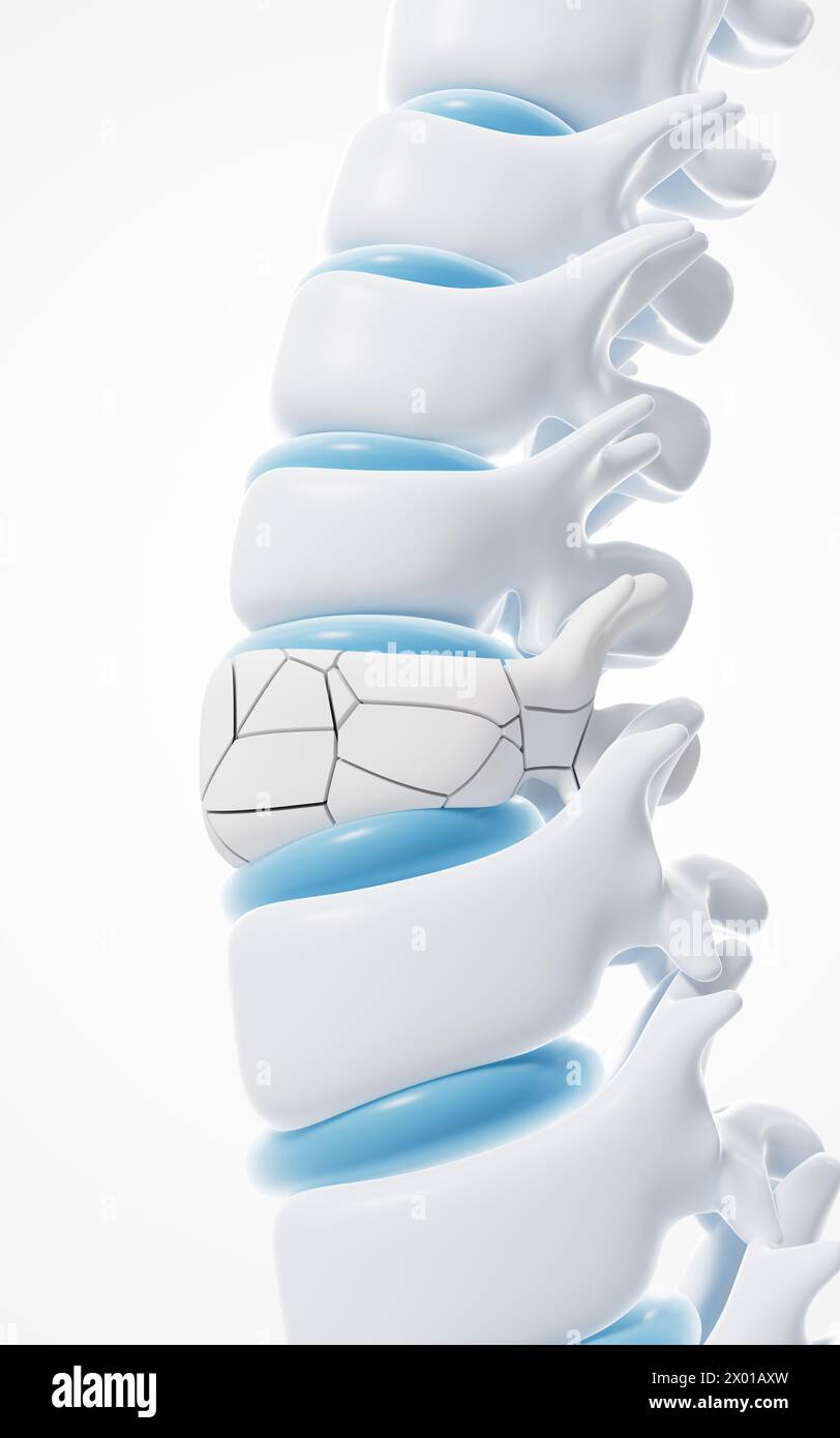 Modelli di vertebre e fratture umane, rendering 3d. illustrazione 3d. Foto Stock