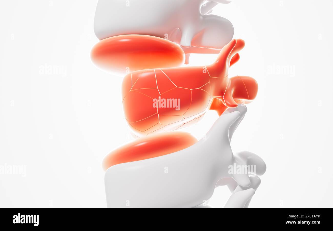 Modelli di vertebre e fratture umane, rendering 3d. illustrazione 3d. Foto Stock