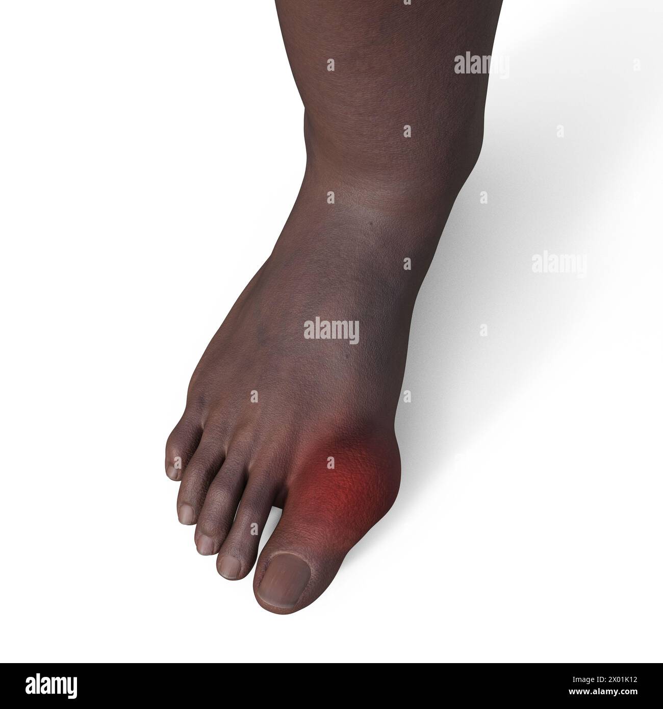 Illustrazione di un piede affetto dalla gotta, che mostra infiammazione e deformità nell'articolazione del piede. Foto Stock