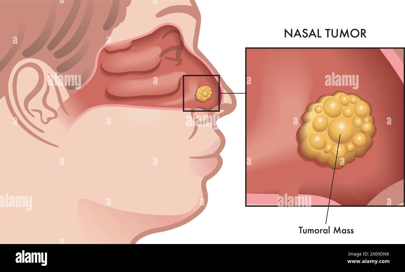 Illustrazione medica di un tumore nasale con un dettaglio ingrandito. Illustrazione Vettoriale