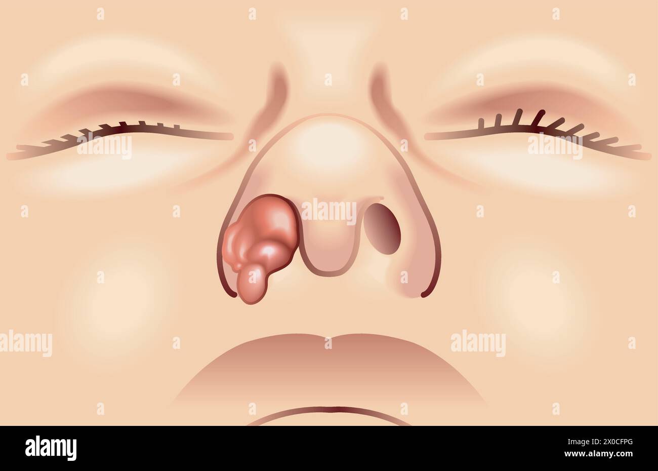 Illustrazione medica di un tumore nasale Illustrazione Vettoriale