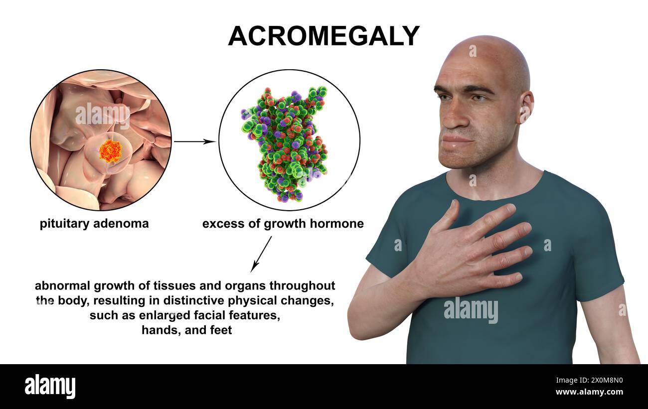 Illustrazione 3D di un uomo con acromegalia. Questa è una condizione che causa un aumento delle dimensioni delle mani e del viso a causa della sovrapproduzione di somatotropina (ormone umano della crescita). In genere è il risultato di un tumore benigno (adenoma) che si forma sulla ghiandola ipofisaria. Foto Stock