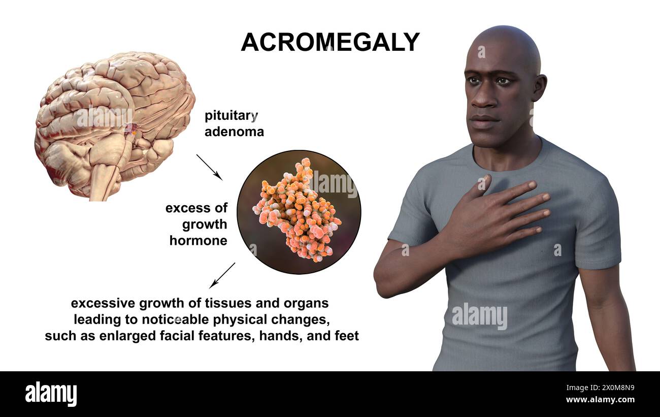 Illustrazione 3D di un uomo con acromegalia. Questa è una condizione che causa un aumento delle dimensioni delle mani e del viso a causa della sovrapproduzione di somatotropina (ormone umano della crescita). In genere è il risultato di un tumore benigno (adenoma) che si forma sulla ghiandola ipofisaria. Foto Stock