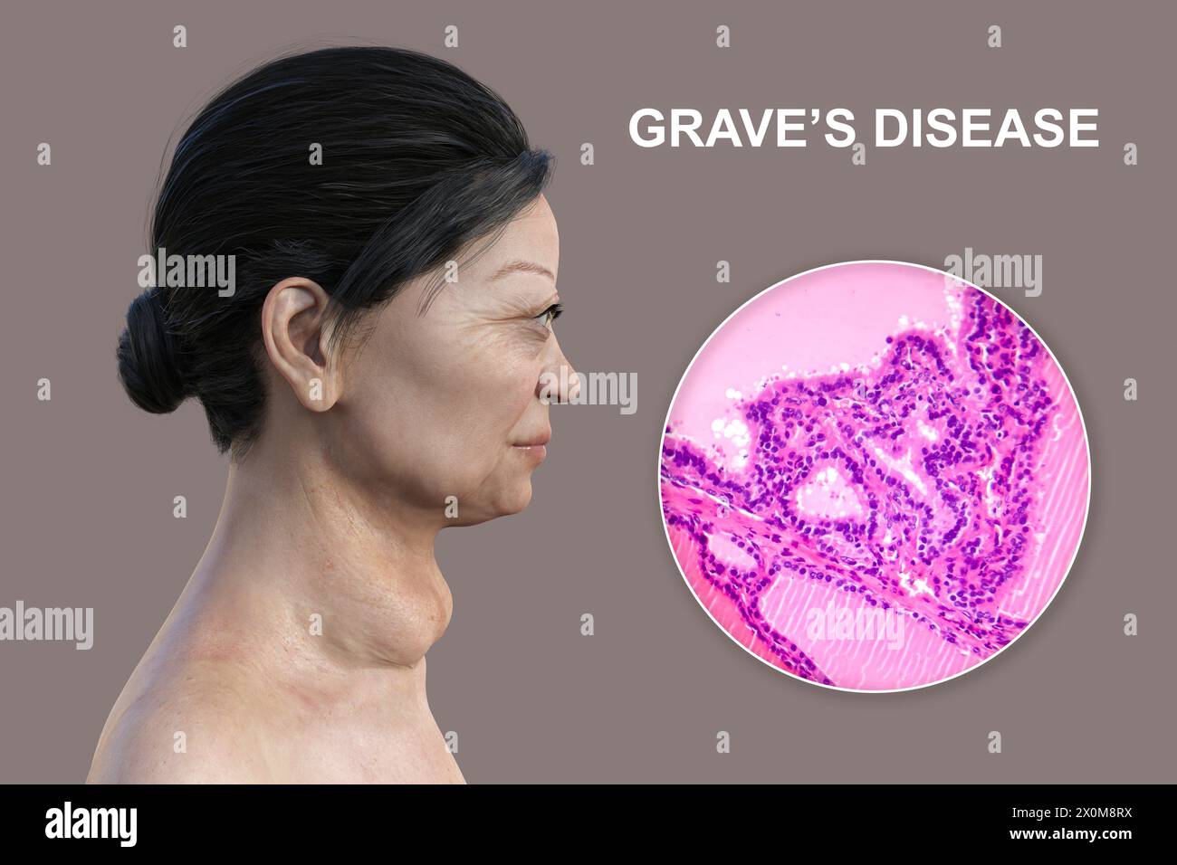 Illustrazione 3D di una donna con malattia di Graves e un primo piano del tessuto tiroideo interessato. La malattia di Graves può causare un ingrossamento della ghiandola tiroidea (gozzo, base del collo) a svilupparsi, e può causare un'eccessiva sporgenza degli occhi (esoftalmo). La malattia di Graves è una condizione autoimmune in cui vengono prodotti anticorpi che causano alla ghiandola tiroidea di produrre ormoni eccessivi. Foto Stock