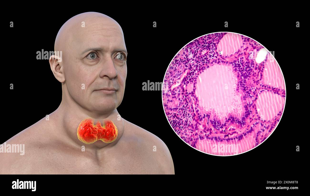 Illustrazione 3D di un uomo con gozzo tossico (ghiandola tiroidea allargata, base del collo) e un primo piano del tessuto tiroideo interessato. Un gozzo è considerato tossico quando l'ingrossamento della ghiandola tiroidea produce anche un eccesso di ormone tiroideo. Foto Stock