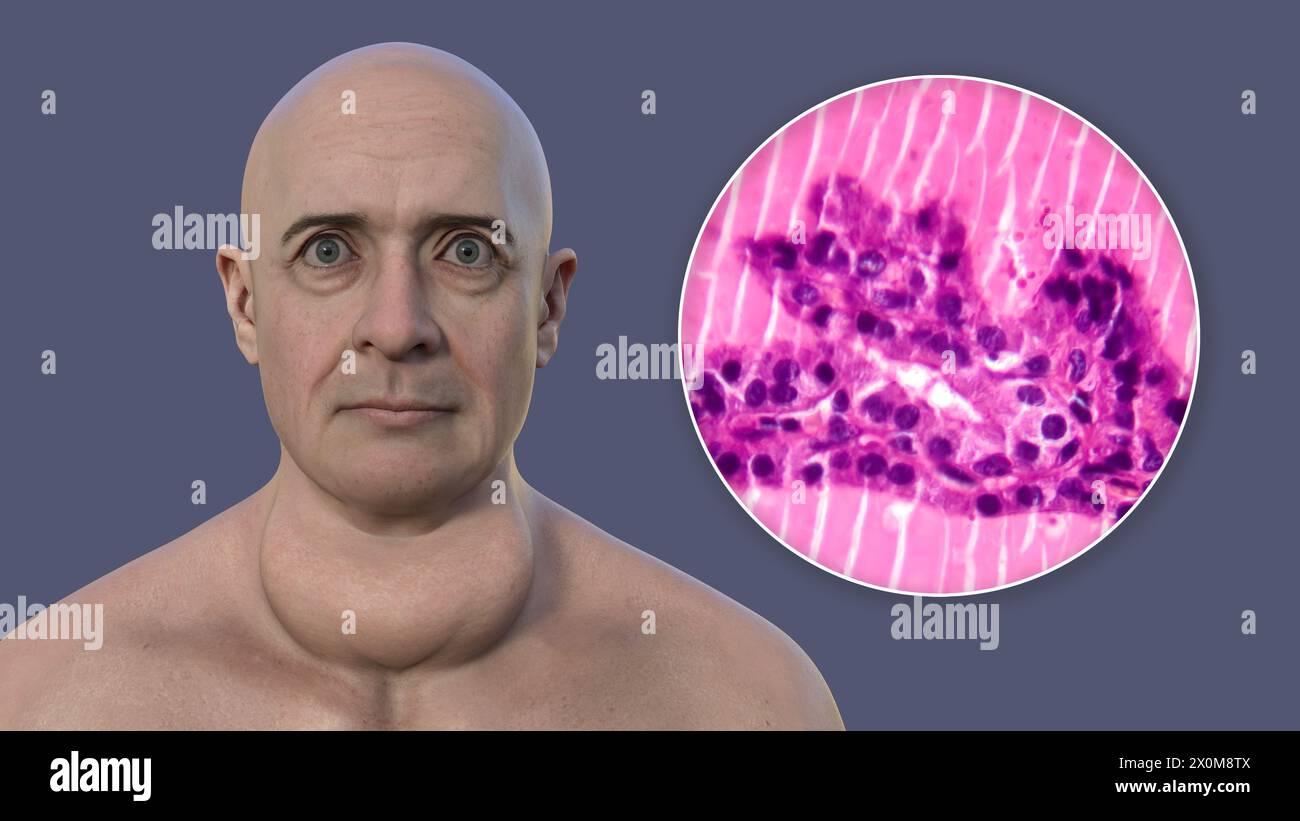 Illustrazione 3D di un uomo con gozzo tossico (ghiandola tiroidea allargata, base del collo) e un primo piano del tessuto tiroideo interessato. Un gozzo è considerato tossico quando l'ingrossamento della ghiandola tiroidea produce anche un eccesso di ormone tiroideo. Foto Stock