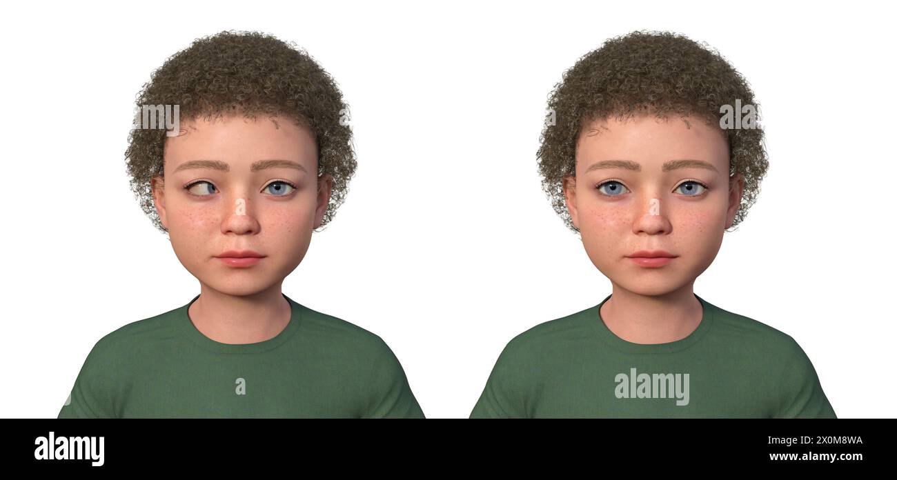 Illustrazione di un bambino con esotropia che mostra il disallineamento degli occhi verso l'interno e lo stesso bambino sano. Foto Stock