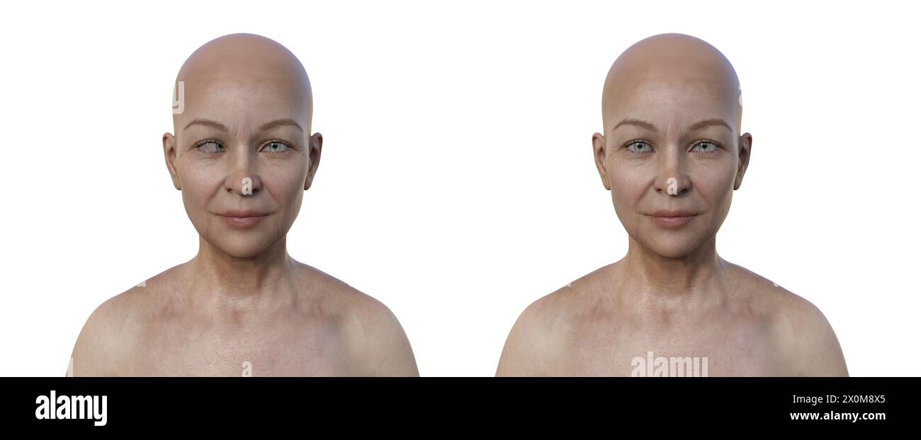 Illustrazione di una donna con esotropia che mostra il disallineamento degli occhi verso l'interno e la stessa donna sana. Foto Stock