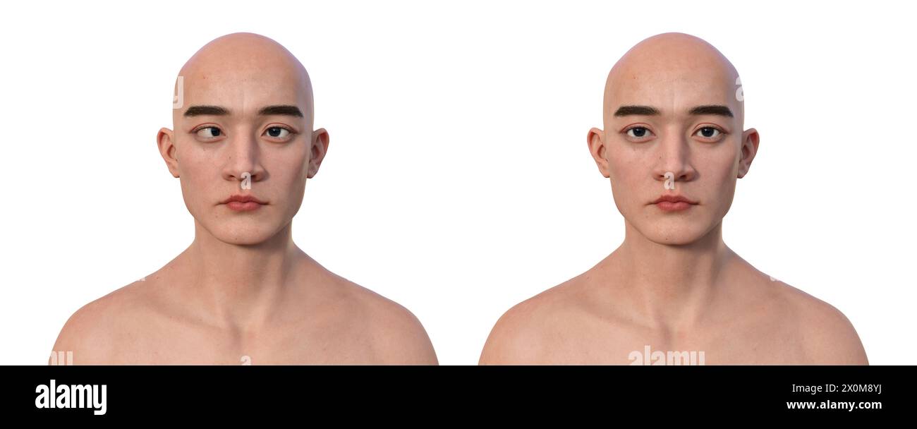 Illustrazione di un uomo con esotropia che mostra il disallineamento degli occhi verso l'interno e lo stesso uomo sano. Foto Stock