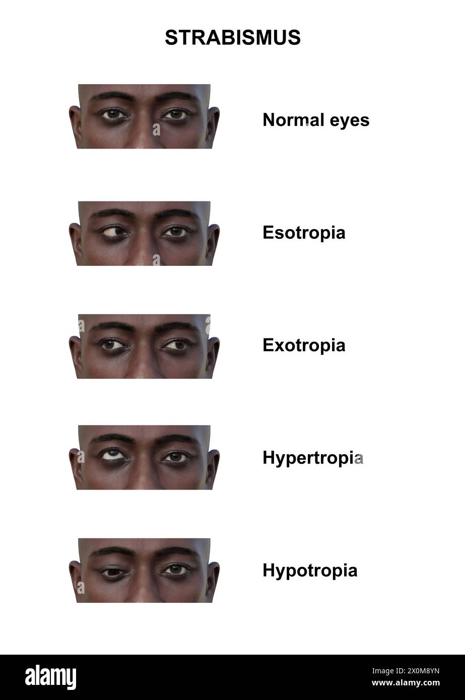 Illustrazione di un uomo con vari tipi di strabismo: Esotropia, esotropia, ipertropia e ipotropia. Foto Stock