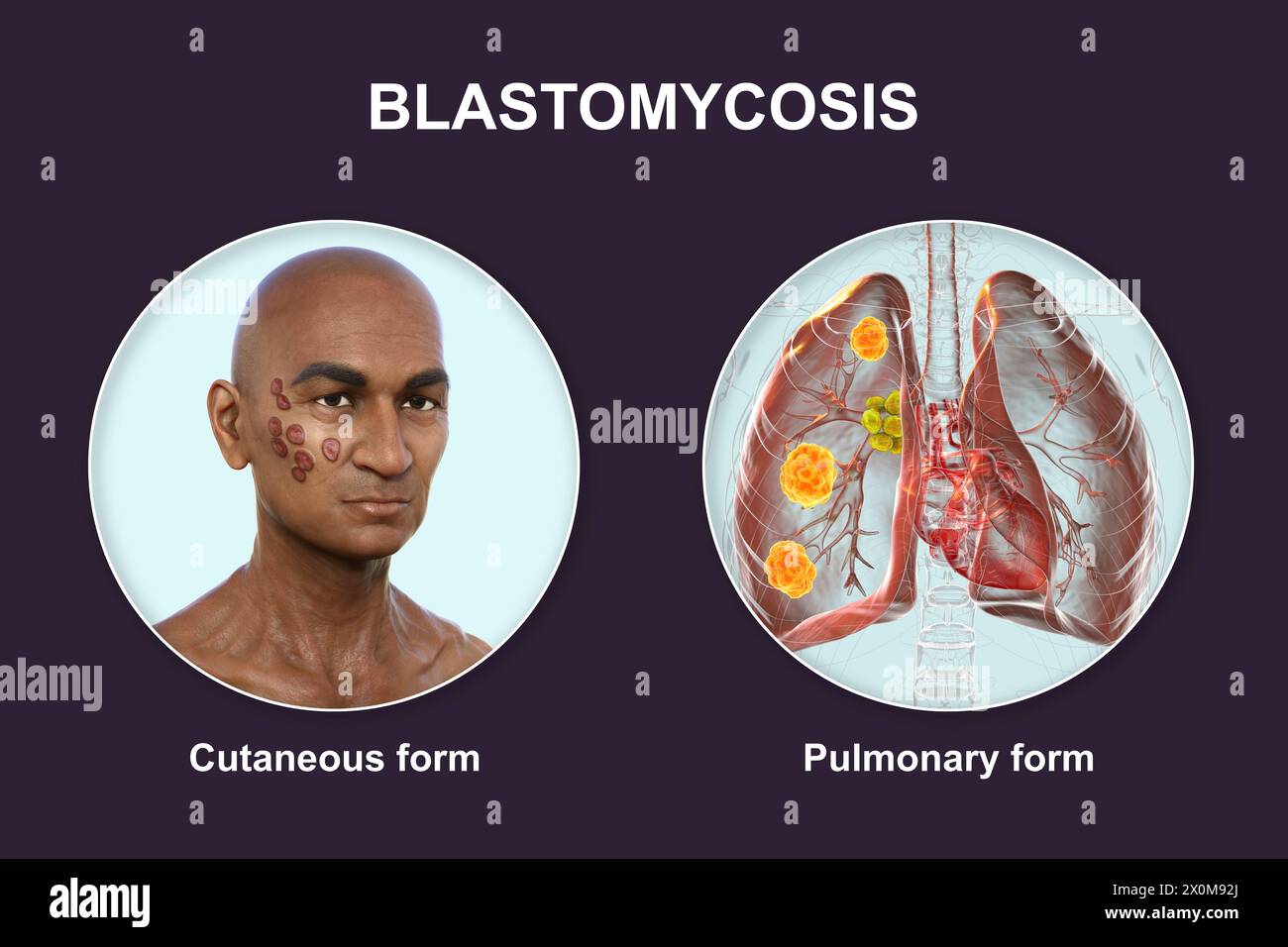 Illustrazione 3D che mostra due presentazioni cliniche della blastomicosi: Cutanea (che colpisce la pelle) e polmonare (che colpisce i polmoni). Blastomicosi Foto Stock