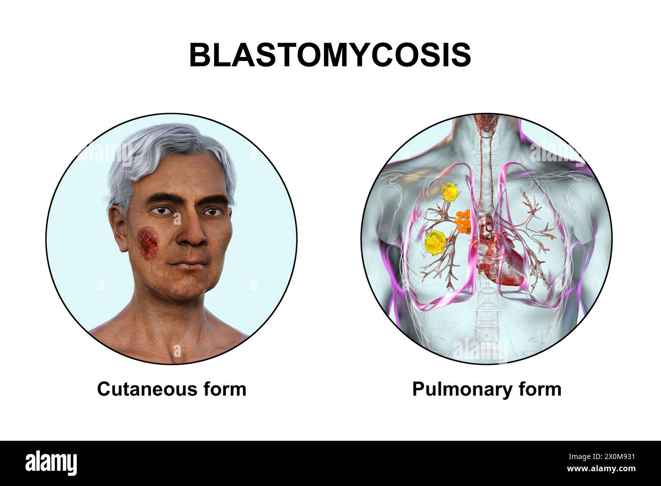 Illustrazione 3D che mostra due presentazioni cliniche della blastomicosi: Cutanea (che colpisce la pelle) e polmonare (che colpisce i polmoni). La blastomicosi è un'infezione fungina che può verificarsi dopo l'inalazione delle spore di Blastomyces dermatitidis. È spesso asintomatico, ma dove i sintomi si sviluppano colpiscono principalmente i polmoni, con alcuni pazienti che sviluppano anche lesioni cutanee. Foto Stock Illustrazione 3D che mostra due presentazioni cliniche della blastomicosi: Cutanea (che colpisce la pelle) e polmonare (che colpisce i polmoni). La blastomicosi è un'infezione fungina che può verificarsi dopo l'inalazione delle spore di Blastomyces dermatitidis. È spesso asintomatico, ma dove i sintomi si sviluppano colpiscono principalmente i polmoni, con alcuni pazienti che sviluppano anche lesioni cutanee. Foto Stock