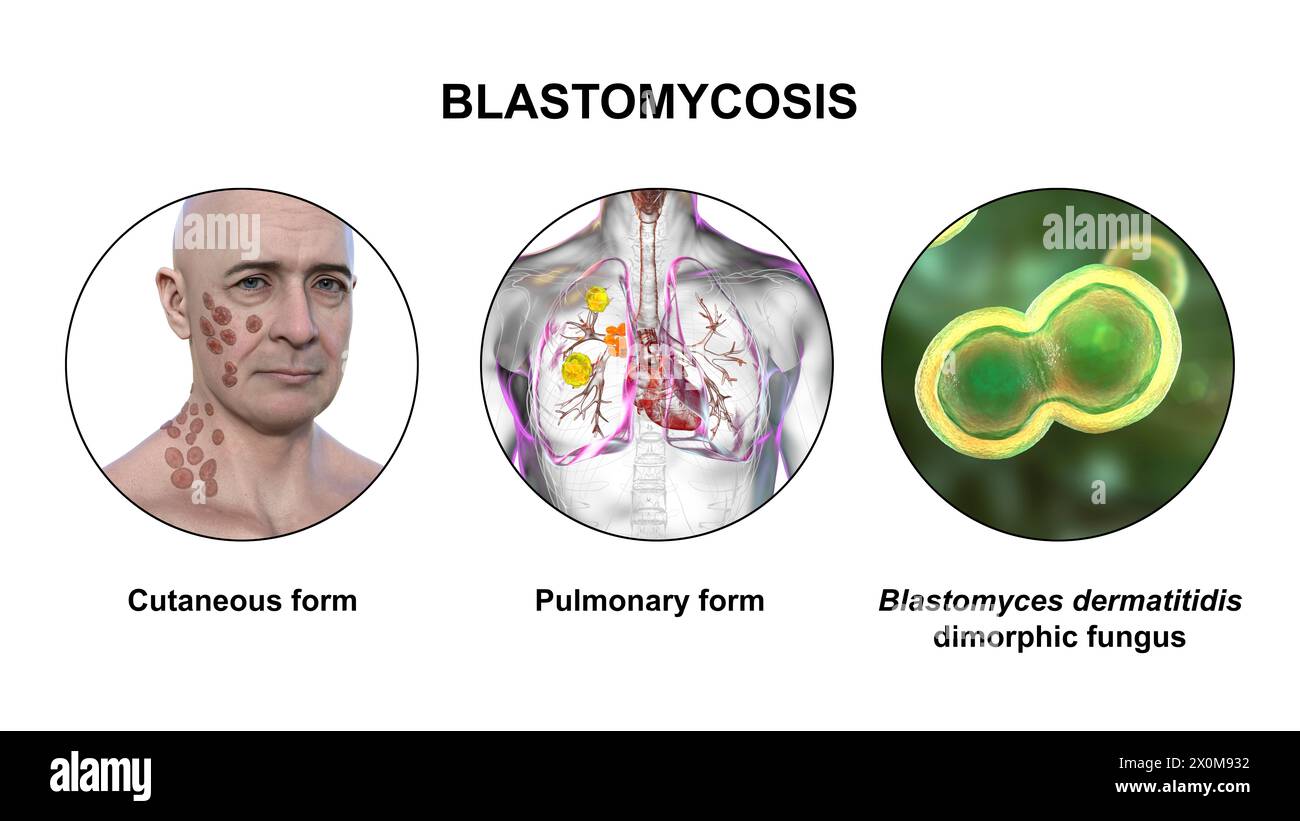 Illustrazione 3D che mostra due presentazioni cliniche della blastomicosi e una vista ravvicinata dei funghi Blastomyces dermatitidis. La blastomicosi è un'infezione fungina che può verificarsi quando le spore di Blastomyces dermatitidis vengono inalate. L'infezione colpisce principalmente i polmoni (polmonari), con alcuni pazienti che sviluppano anche sintomi cutanei (cutanei) come lesioni. Foto Stock Illustrazione 3D che mostra due presentazioni cliniche della blastomicosi e una vista ravvicinata dei funghi Blastomyces dermatitidis. La blastomicosi è un'infezione fungina che può verificarsi quando le spore di Blastomyces dermatitidis vengono inalate. L'infezione colpisce principalmente i polmoni (polmonari), con alcuni pazienti che sviluppano anche sintomi cutanei (cutanei) come lesioni. Foto Stock