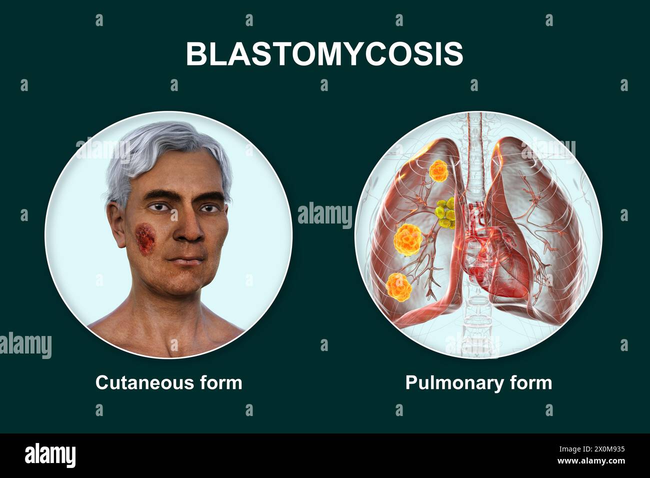 Illustrazione 3D che mostra due presentazioni cliniche della blastomicosi: Cutanea (che colpisce la pelle) e polmonare (che colpisce i polmoni). La blastomicosi è un'infezione fungina che può verificarsi dopo l'inalazione delle spore di Blastomyces dermatitidis. È spesso asintomatico, ma dove i sintomi si sviluppano colpiscono principalmente i polmoni, con alcuni pazienti che sviluppano anche lesioni cutanee. Foto Stock