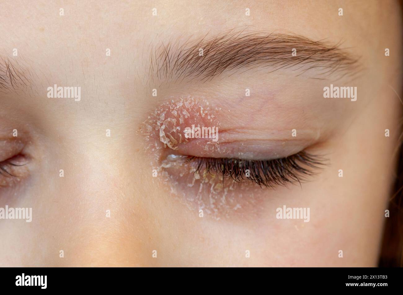 Occhio chiuso di una bambina affetta da dermatite atopica oculare o eczema palpebrale. Foto Stock