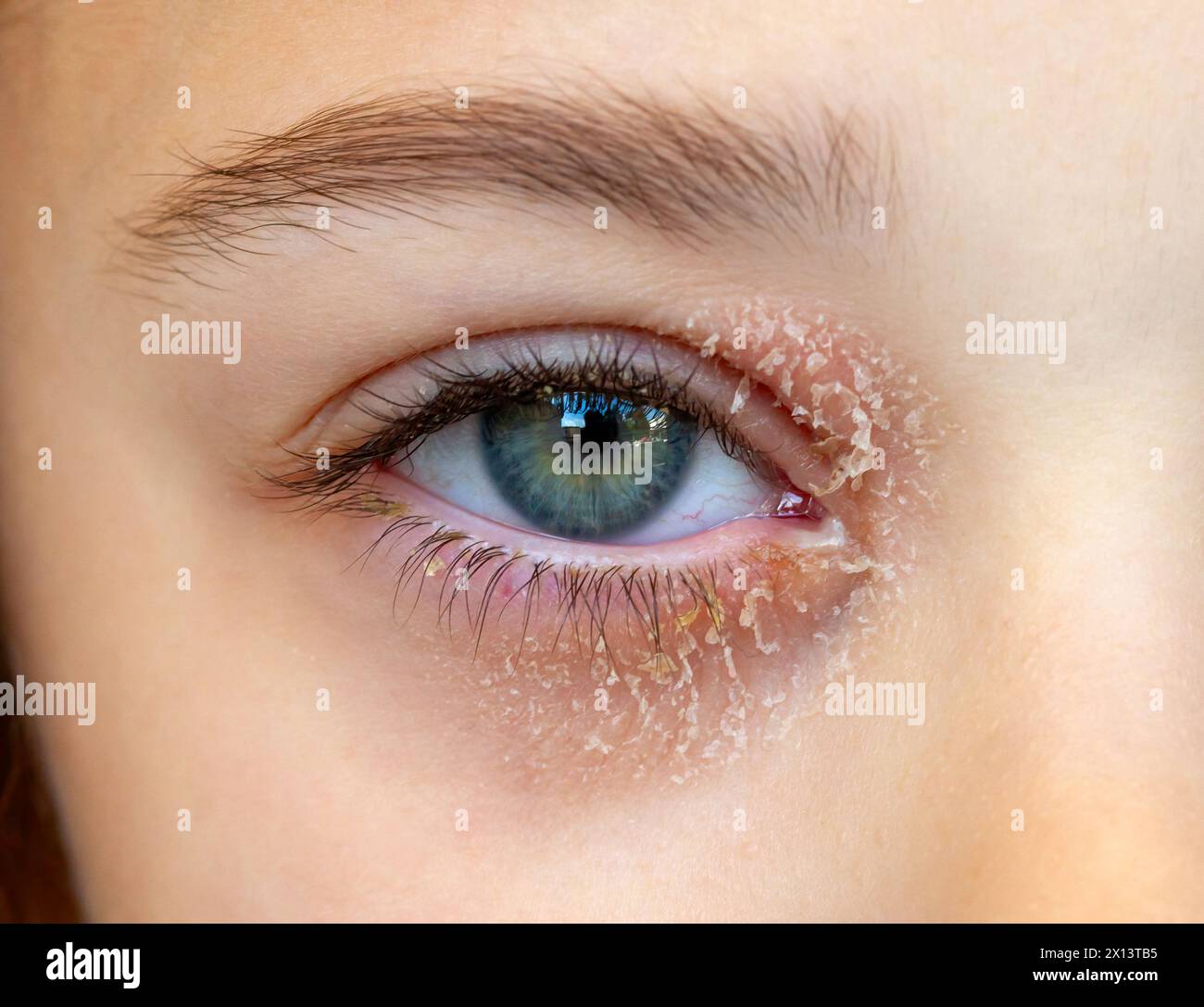 Occhio di una bambina affetta da dermatite atopica oculare o eczema palpebrale. Foto Stock