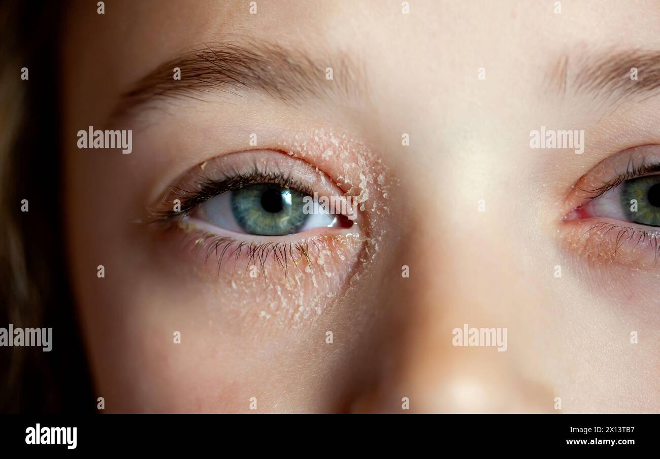 Occhio di una bambina affetta da dermatite atopica oculare o eczema palpebrale. Foto Stock