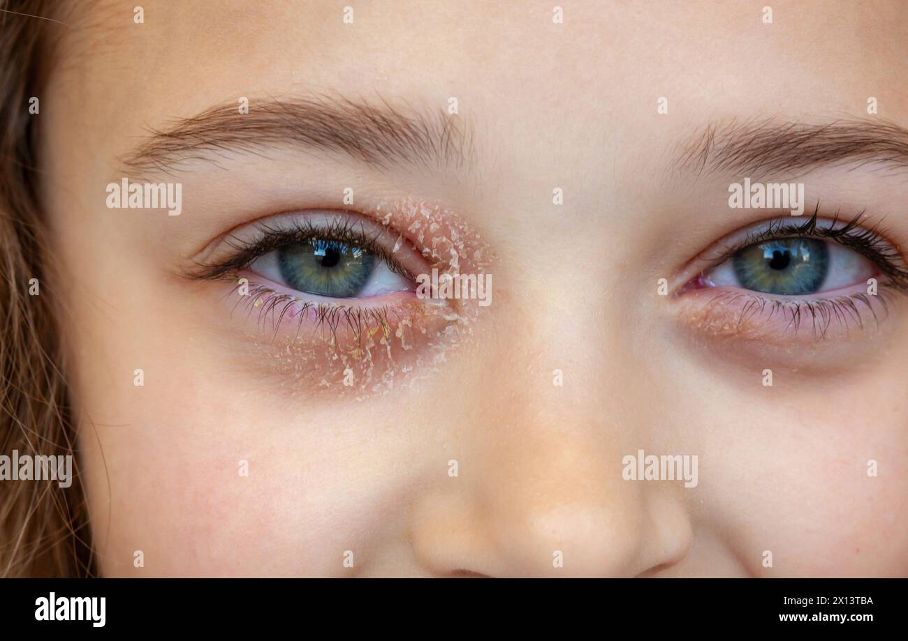 Occhio di una bambina affetta da dermatite atopica oculare o eczema palpebrale. Espressione serena e sorridente. Foto Stock