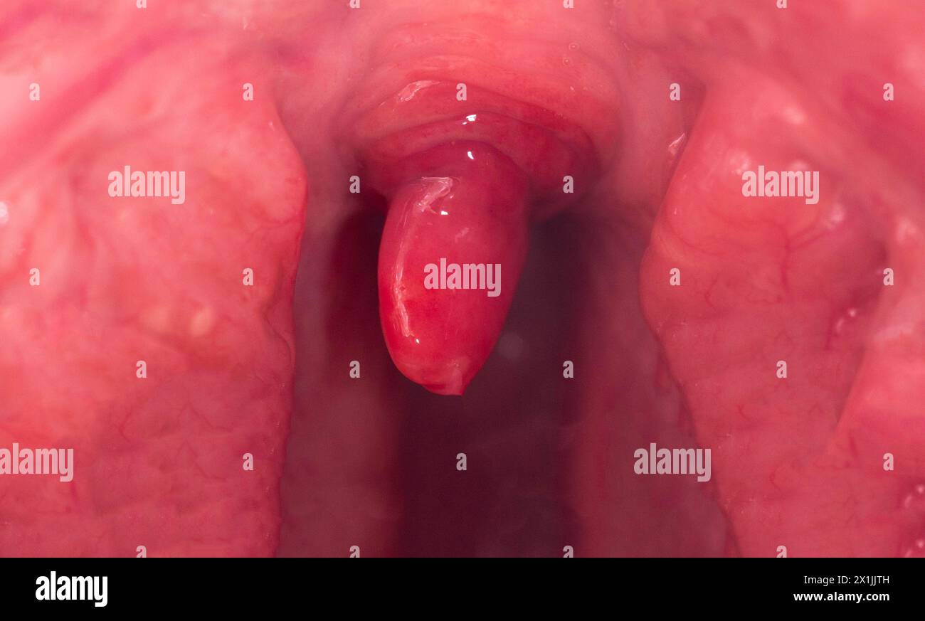 Infiammazione dell'uvula nella cavità orale a causa di infezione e virus. Il trattamento della malattia è l'uvulite. Gola rossa a causa di malattia, macro Foto Stock