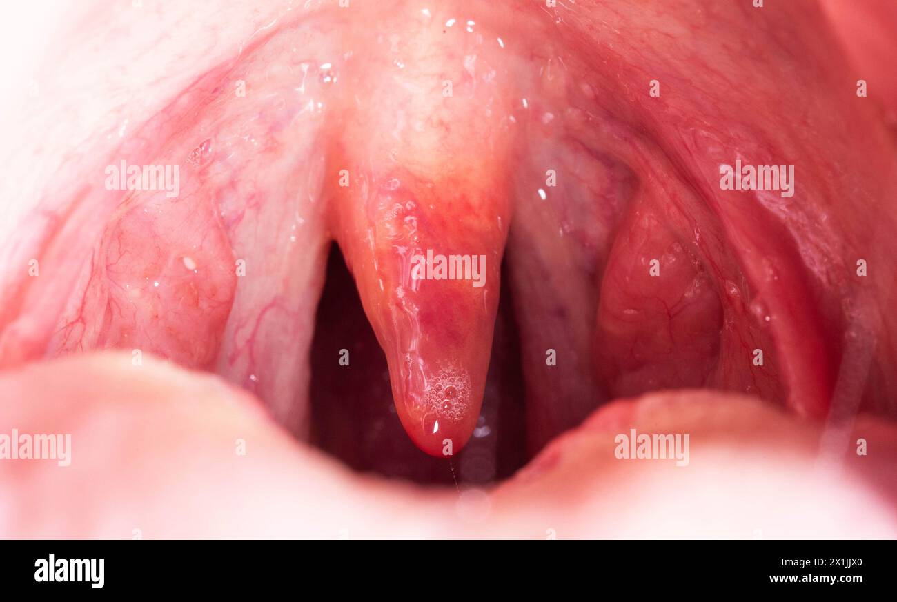 Uvula rossa, infiammata e gonfia in gola. Trattamento dell'uvulite dovuta a batteri e virus streptococcici. Otolaringologia Foto Stock