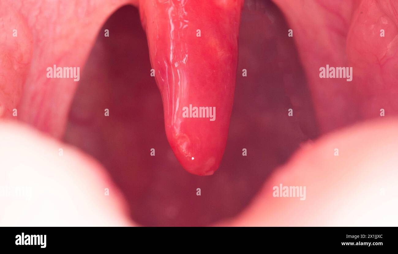 Uvula rossa, infiammata e gonfia in gola. Trattamento dell'uvulite dovuta a batteri e virus streptococcici. Otolaringologia Foto Stock