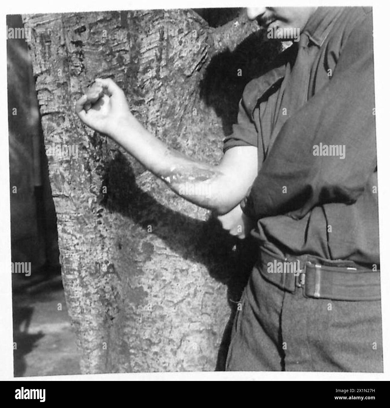 Una serie che illustra le procedure di chirurgia plastica per i soldati moderni mostra una cicatrice sul braccio di Lieut. Jessop (Maxillo-Facial) in Nord Africa, British Army. Foto Stock