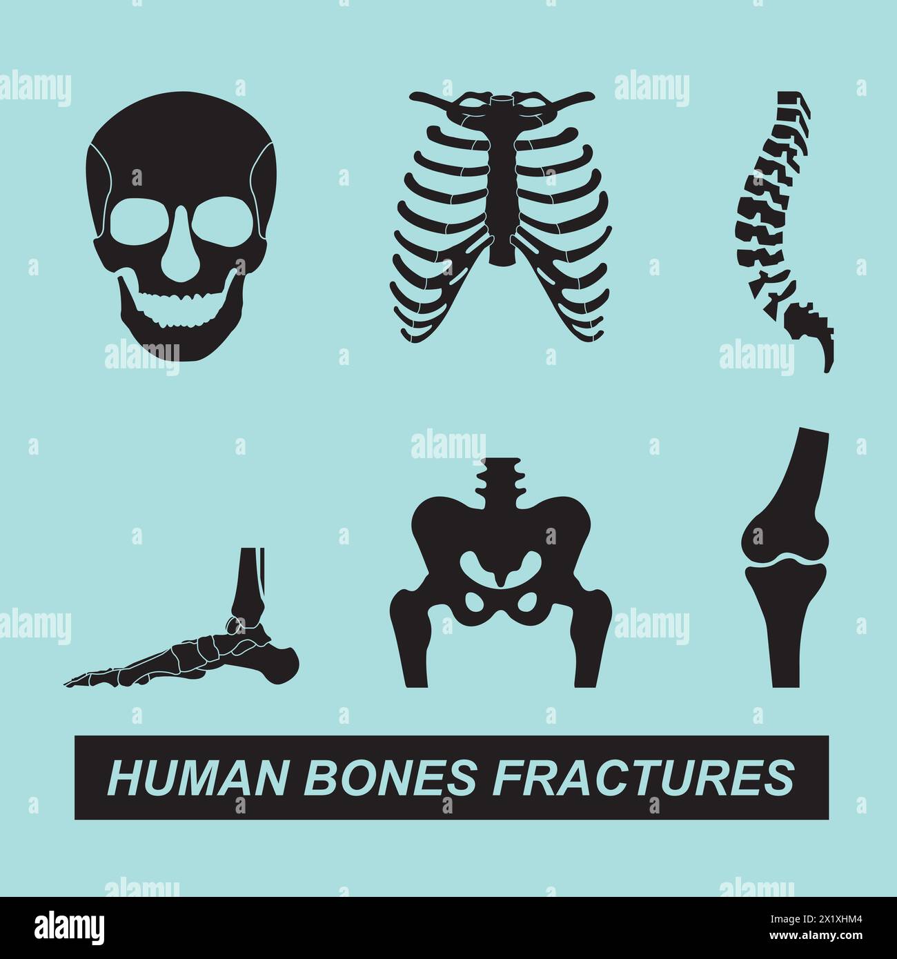 Le ossa umane si fratturano con il disegno del simbolo del vettore Illustrazione Vettoriale