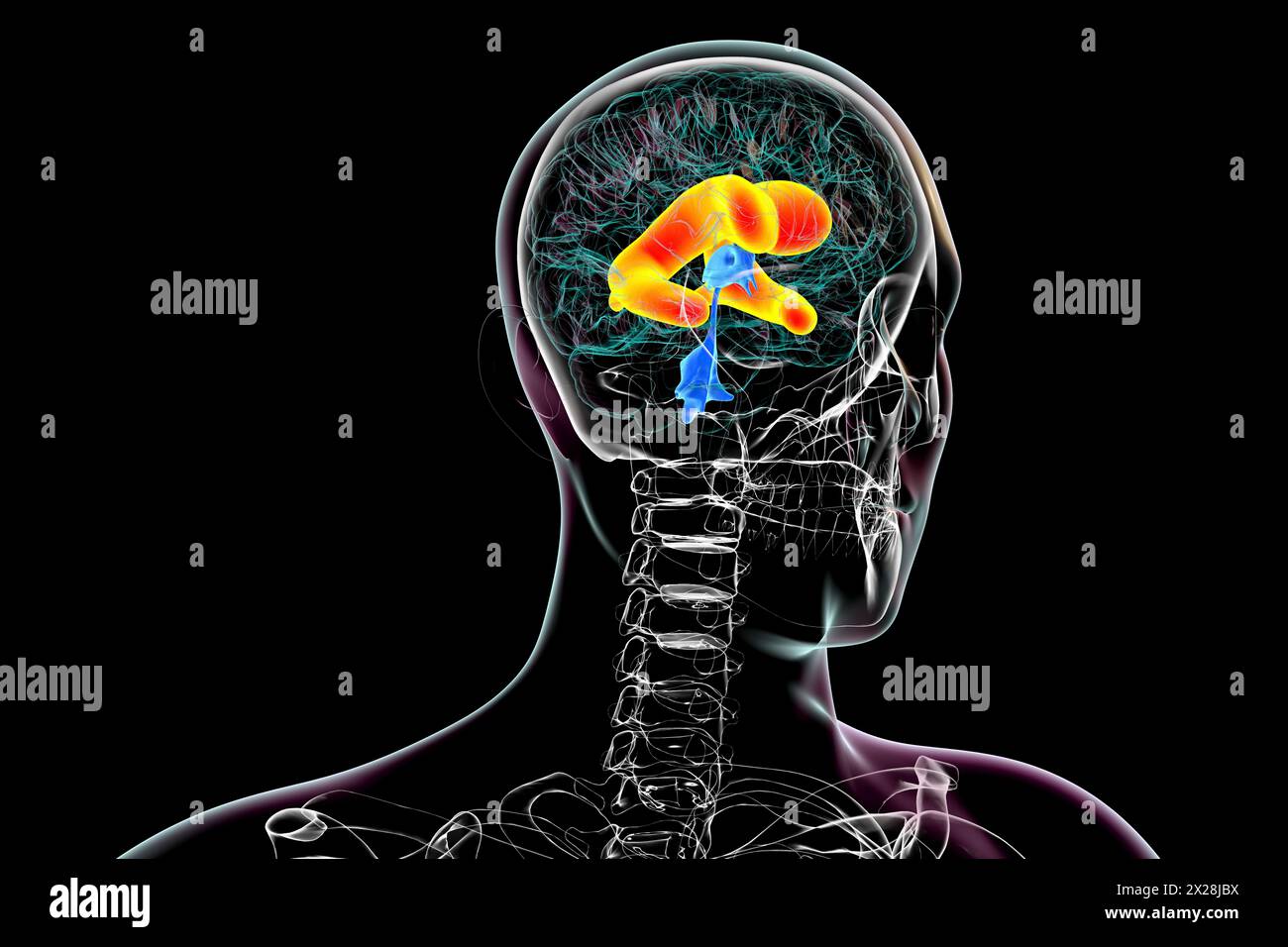 Ventricoli laterali ingranditi del cervello, illustrazione Foto Stock