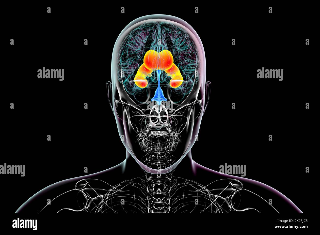 Ventricoli laterali ingranditi del cervello, illustrazione Foto Stock