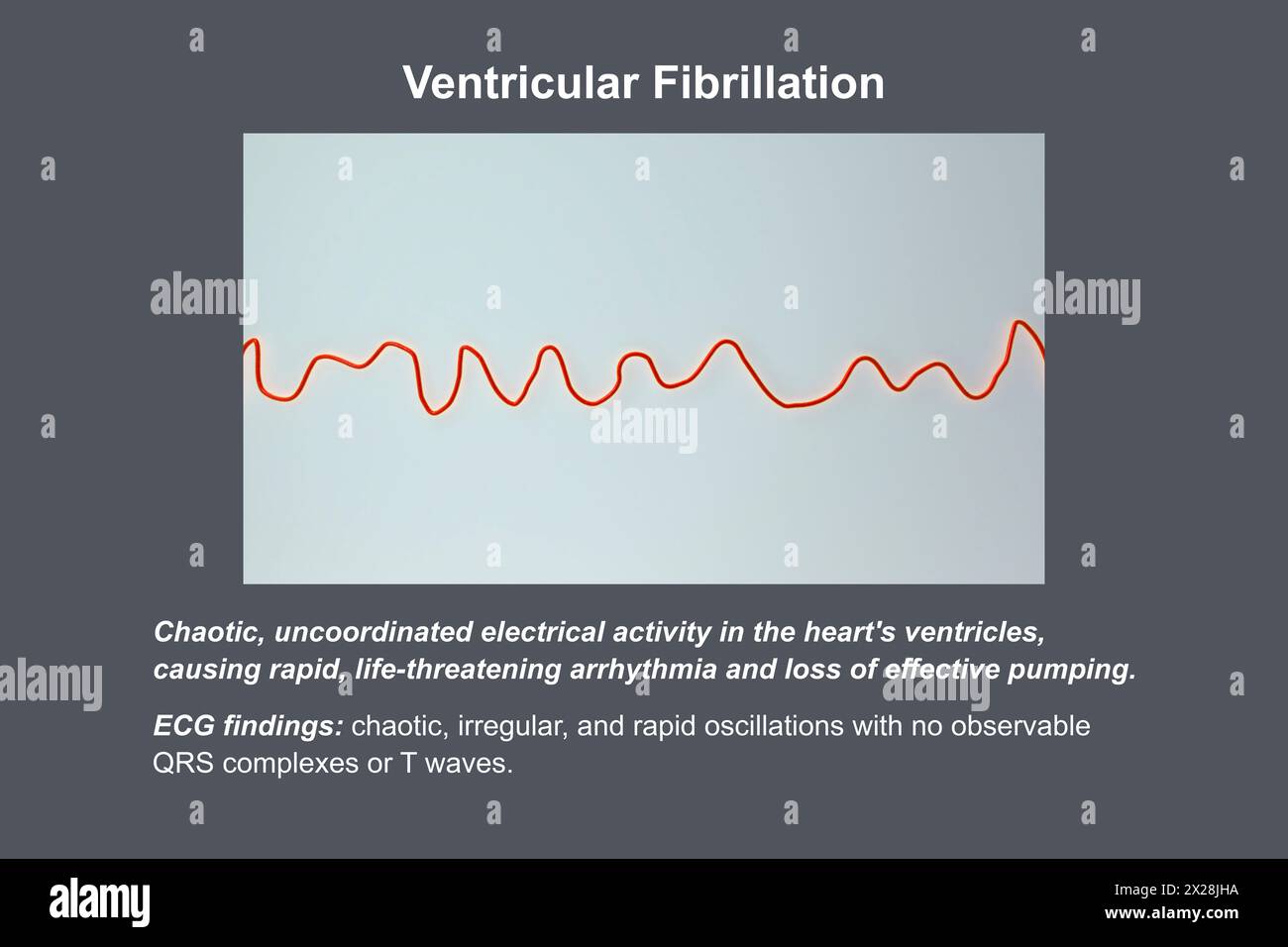 ECG in fibrillazione ventricolare, illustrazione Foto Stock