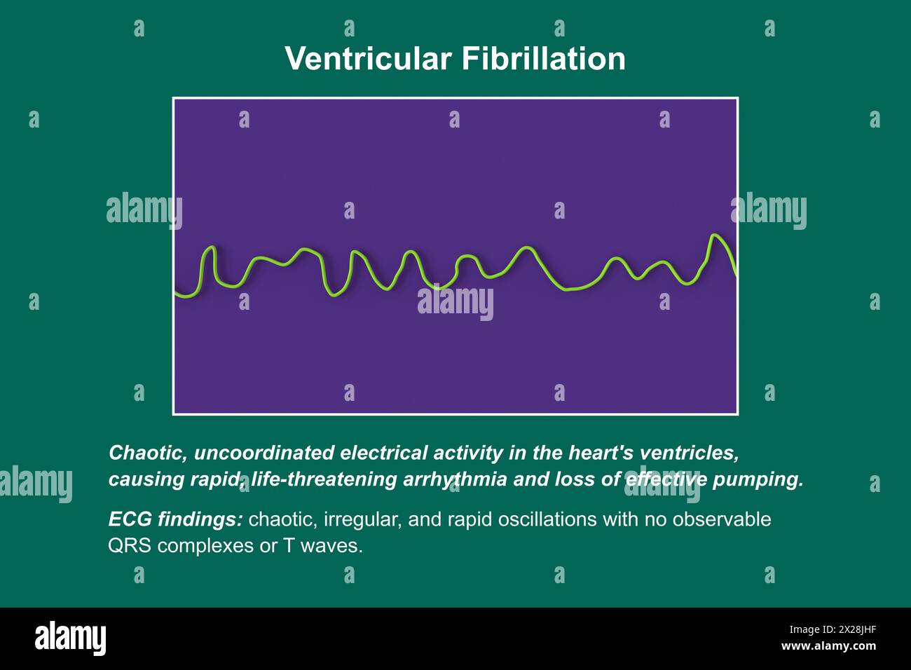 ECG in fibrillazione ventricolare, illustrazione Foto Stock