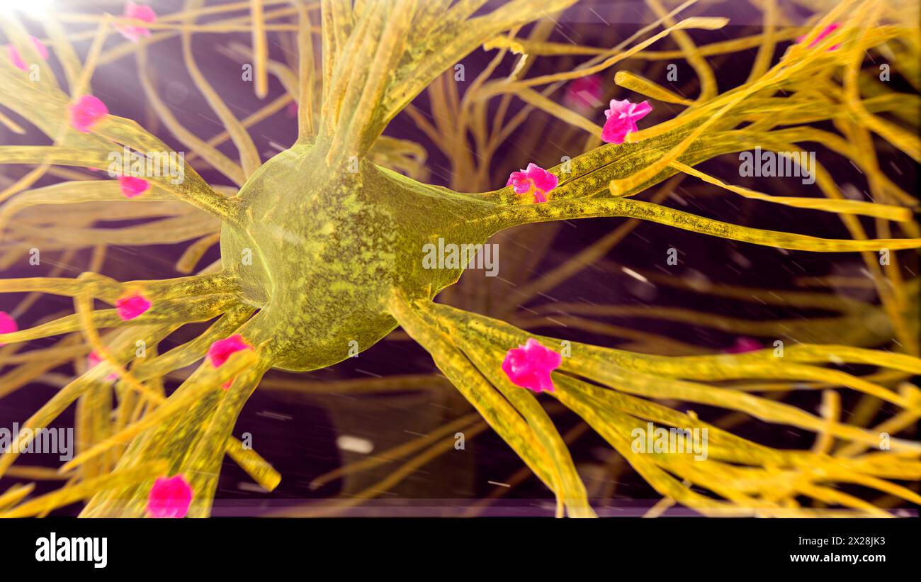 Placche amiloidi sulle cellule nervose, illustrazione Foto Stock
