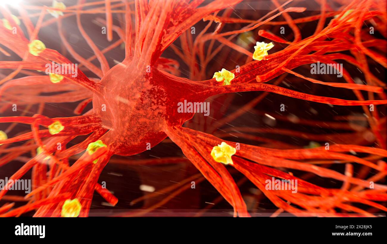 Placche amiloidi sulle cellule nervose, illustrazione Foto Stock