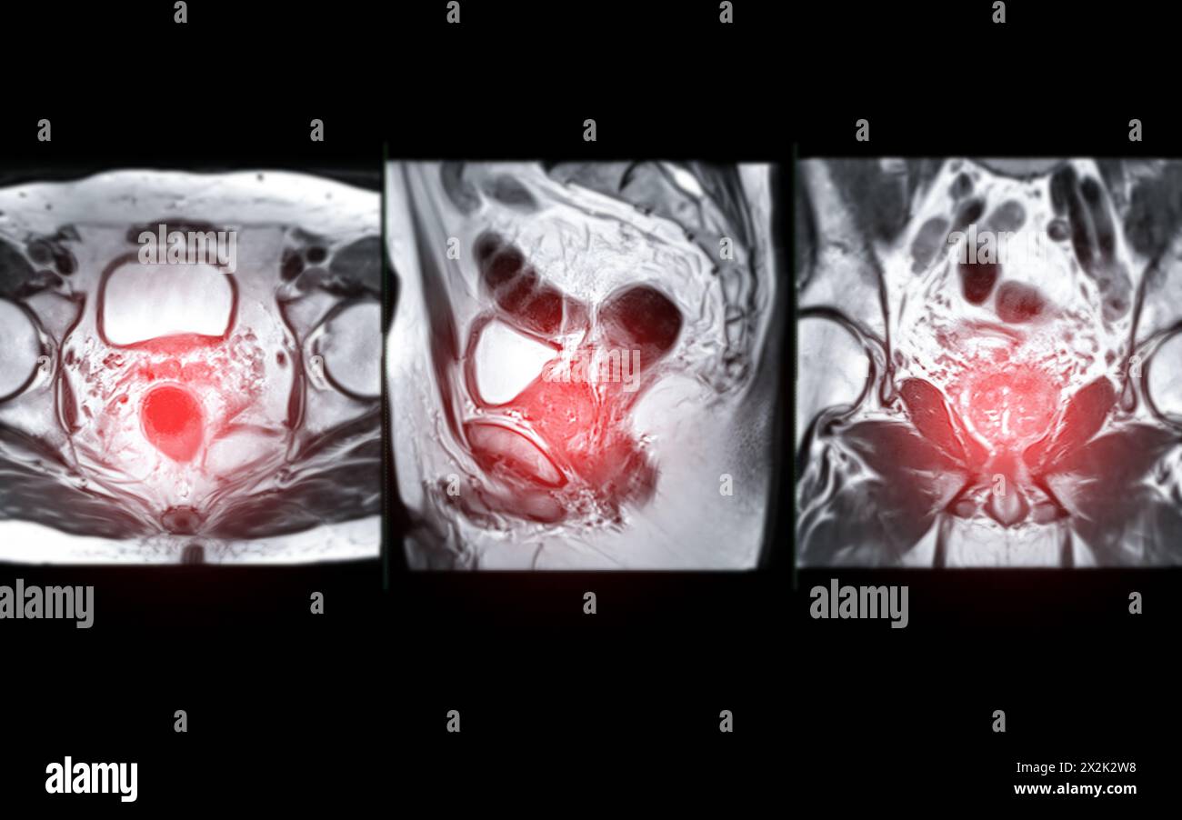 La risonanza magnetica della ghiandola prostatica rivela una lesione si oculare anomala al PZpl sinistro all'apice come descritto; PI-RADS categoria 4, cancro clinicamente significativo è li Foto Stock