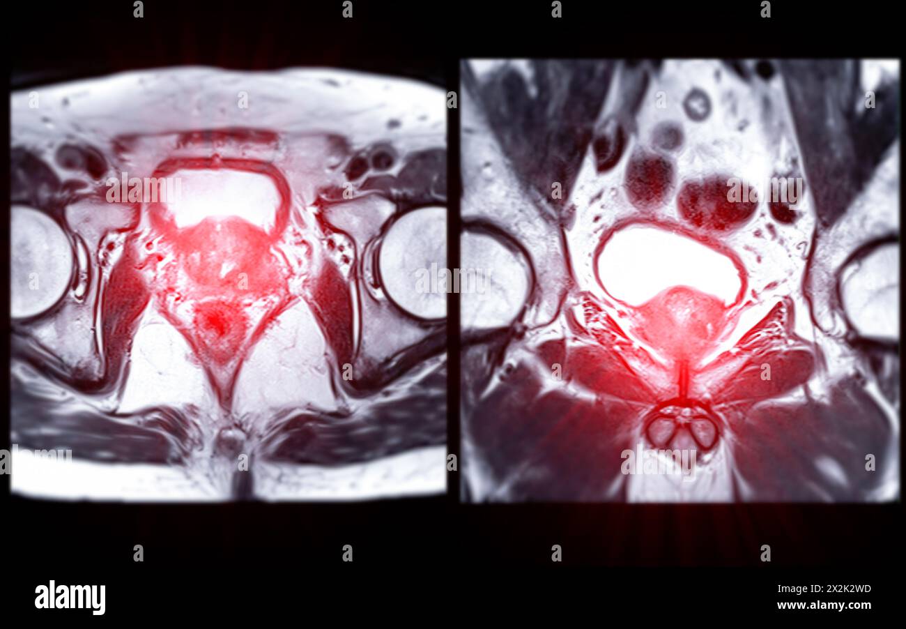 La risonanza magnetica della ghiandola prostatica rivela una lesione si oculare anomala al PZpl sinistro all'apice come descritto; PI-RADS categoria 4, cancro clinicamente significativo è li Foto Stock