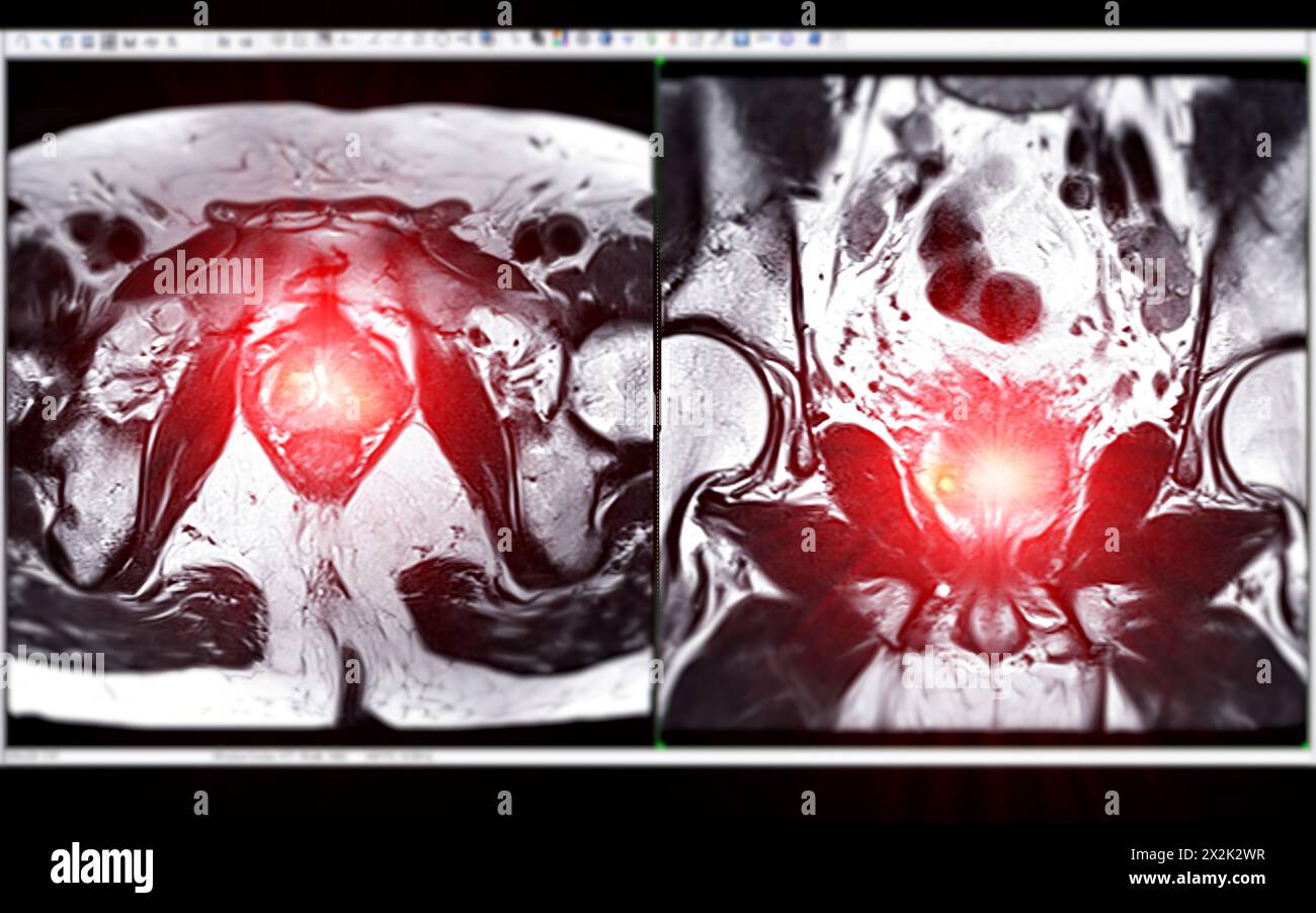 La risonanza magnetica della ghiandola prostatica rivela una lesione si oculare anomala al PZpl sinistro all'apice come descritto; PI-RADS categoria 4, cancro clinicamente significativo è li Foto Stock