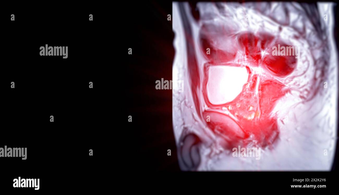 La risonanza magnetica della ghiandola prostatica rivela una lesione si oculare anomala al PZpl sinistro all'apice come descritto; PI-RADS categoria 4, cancro clinicamente significativo è li Foto Stock