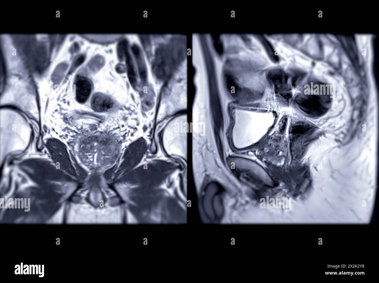 La risonanza magnetica della ghiandola prostatica rivela una lesione si oculare anomala al PZpl sinistro all'apice come descritto; PI-RADS categoria 4, cancro clinicamente significativo è li Foto Stock