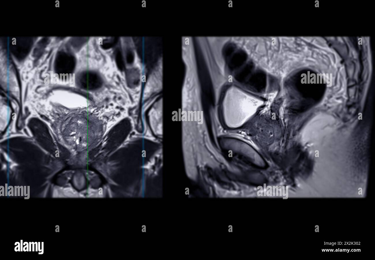 La risonanza magnetica della ghiandola prostatica rivela una lesione si oculare anomala al PZpl sinistro all'apice come descritto; PI-RADS categoria 4, cancro clinicamente significativo è li Foto Stock