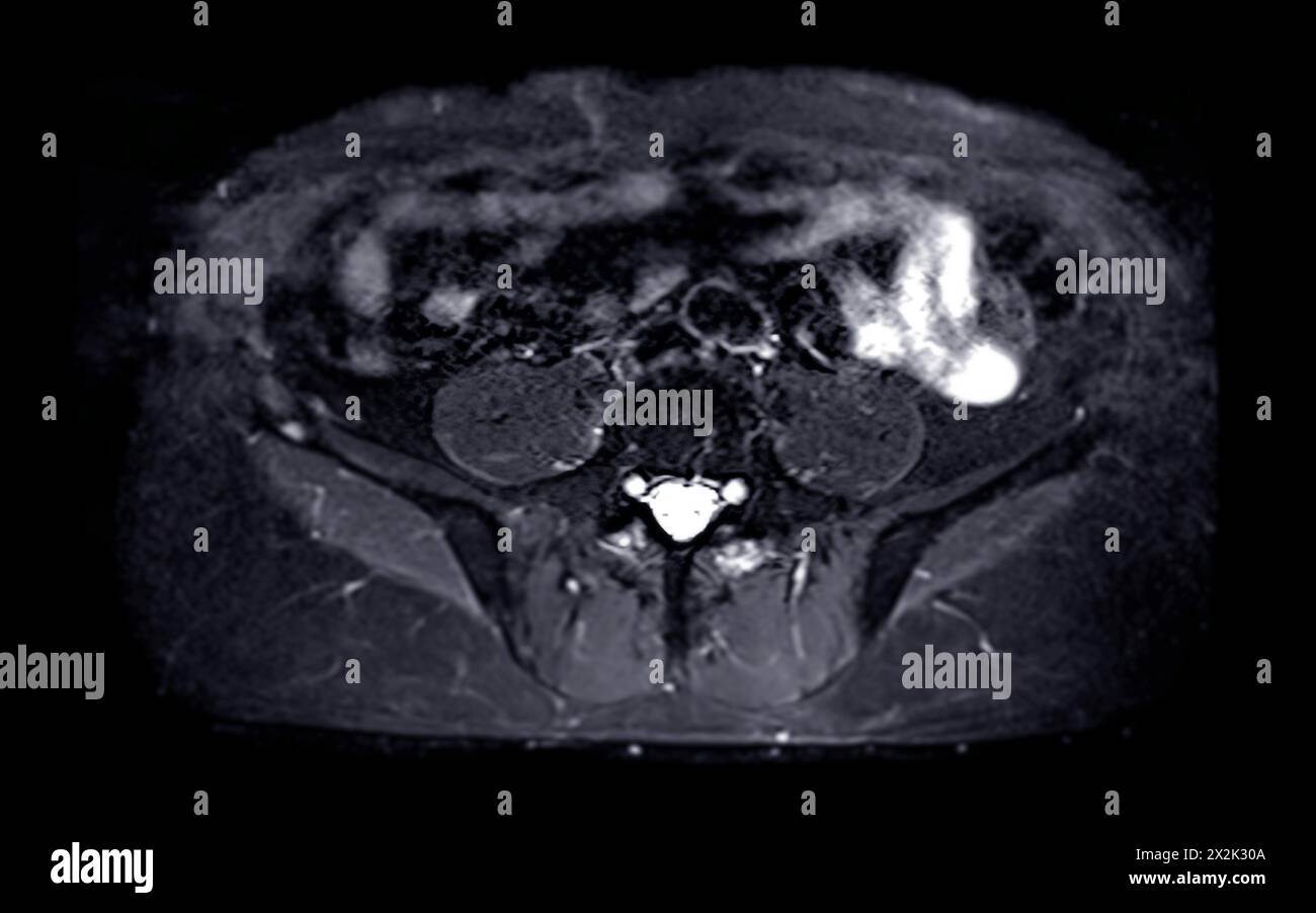 La risonanza magnetica della ghiandola prostatica rivela una lesione si oculare anomala al PZpl sinistro all'apice come descritto; PI-RADS categoria 4, cancro clinicamente significativo è li Foto Stock